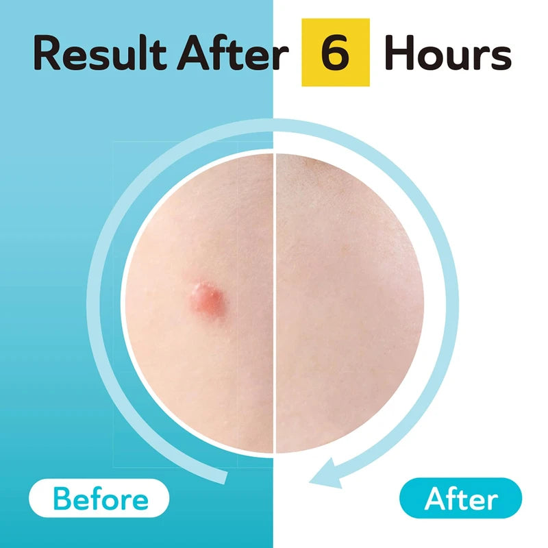 Clear acne patch result on skin, before-and-after 6 hours